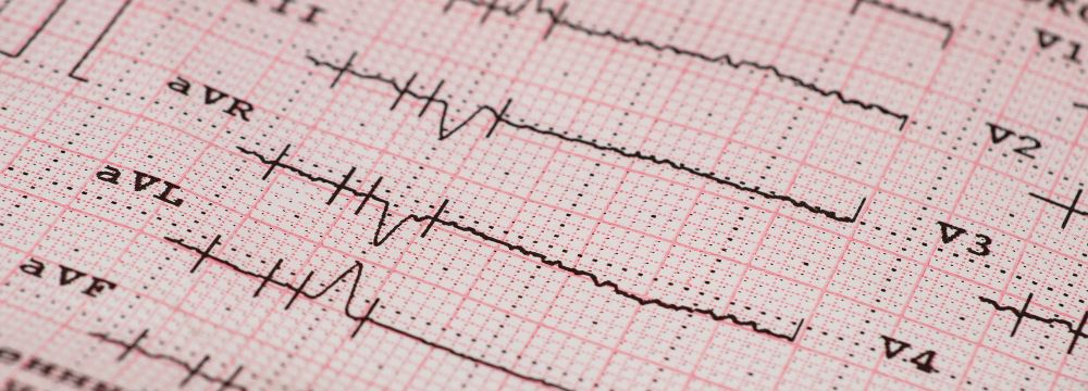 EKG reading of heartbeat 
