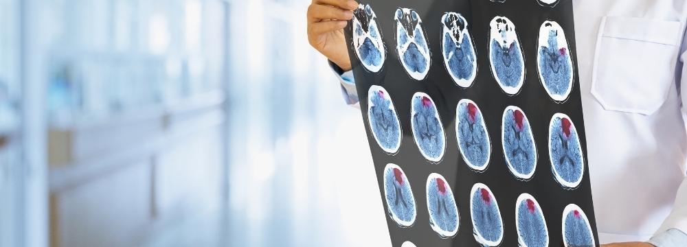 Doctor holds CT scan showing stroke in patient's brain